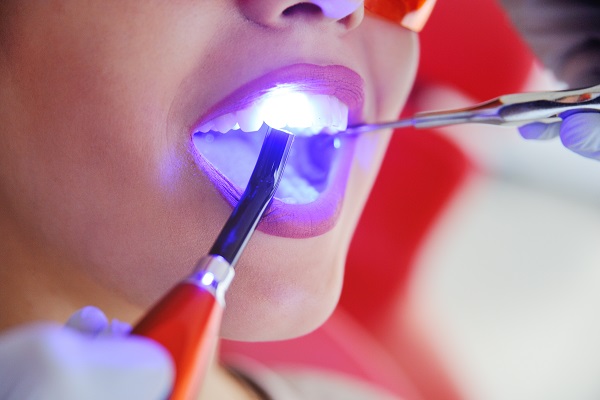 What Is Dental Bonding?