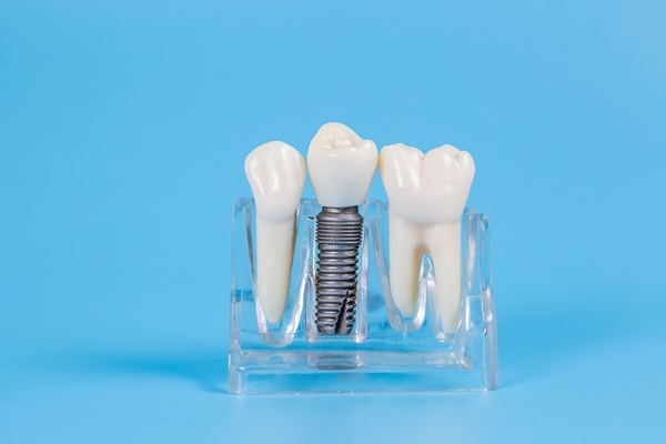 How A Tooth Is Prepared To Have A Dental Crown Restoration