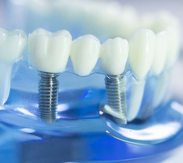 Lemoore Dental Implants