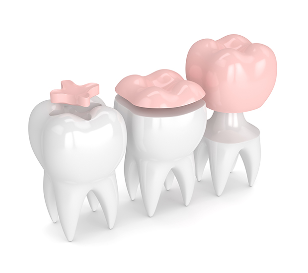 Lemoore Dental Inlays and Onlays