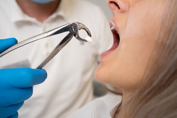 A Step By Step Guide To A Tooth Extraction Procedure